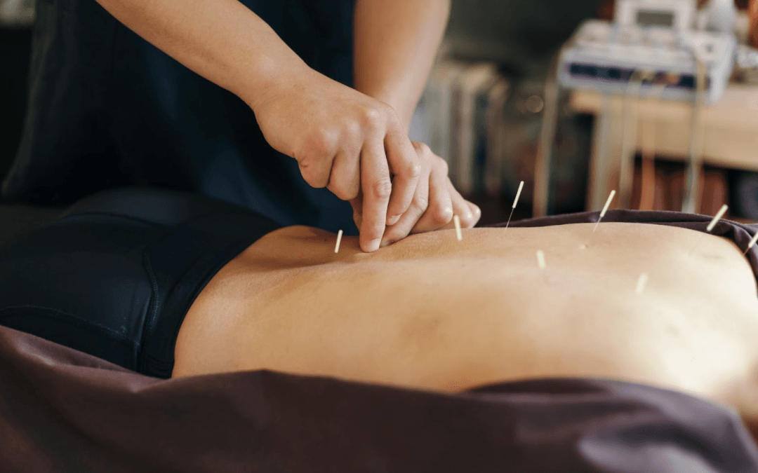 A person receives acupuncture needles in their bare back from a practitioner in a clinical setting.